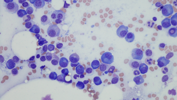 Oral Lymphomas and Multiple Myeloma